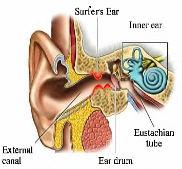 Ear exosostis